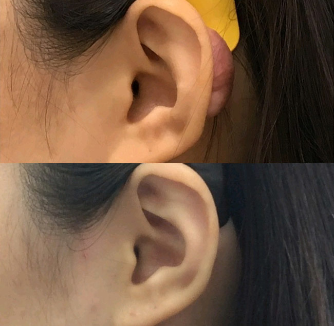 미용흉터성형 켈로이드