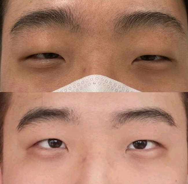 눈성형 남자 쌍커풀 눈매교정