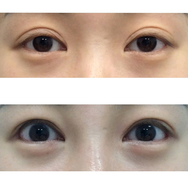 눈성형 절개쌍커풀 눈매교정 애교지방이식
