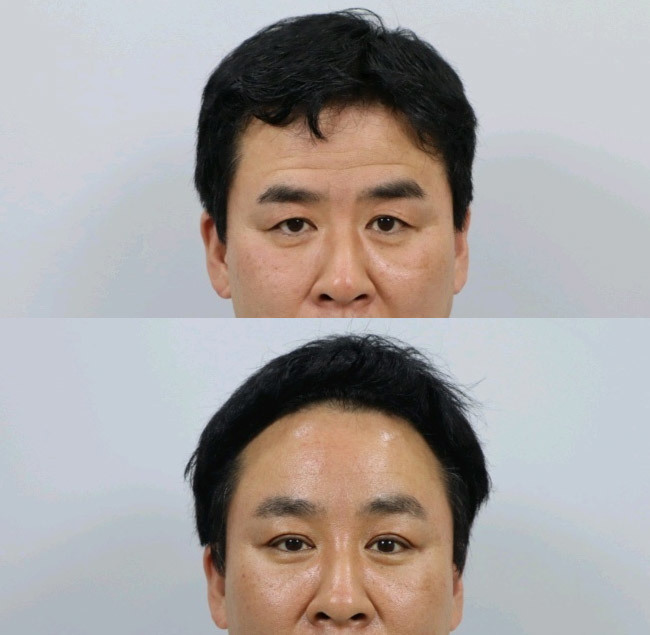 리프팅 50대 상안검 이마거상