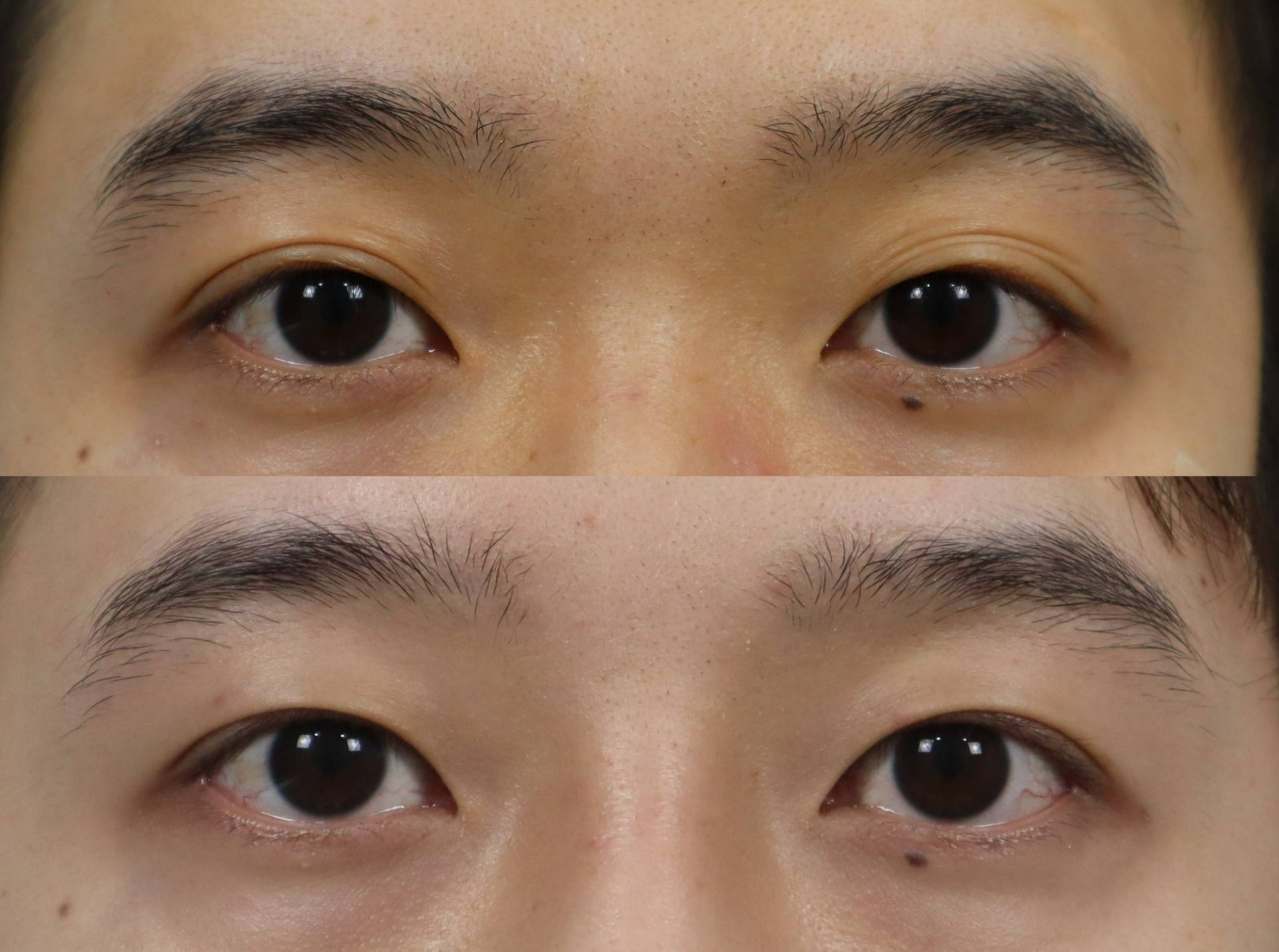 #매몰쌍꺼풀 #눈두덩이지방이식