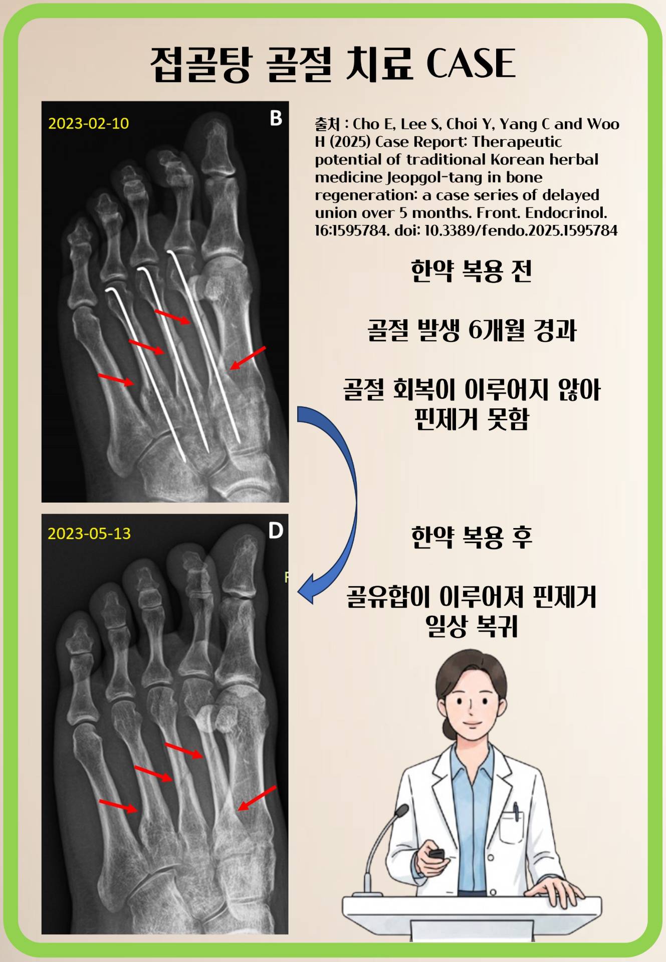 중족골 골절 회복