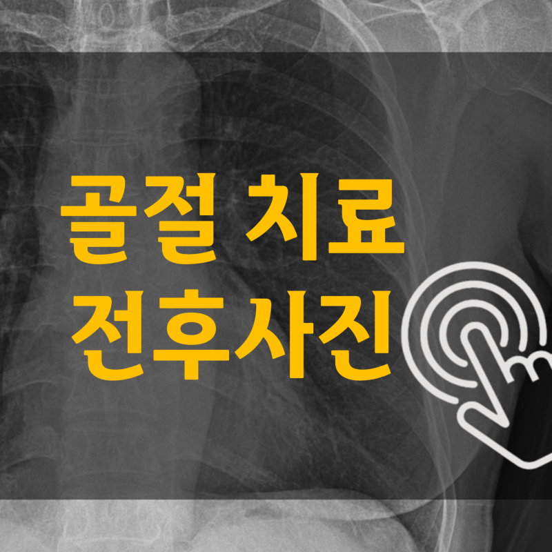 골절 치료 바로가기